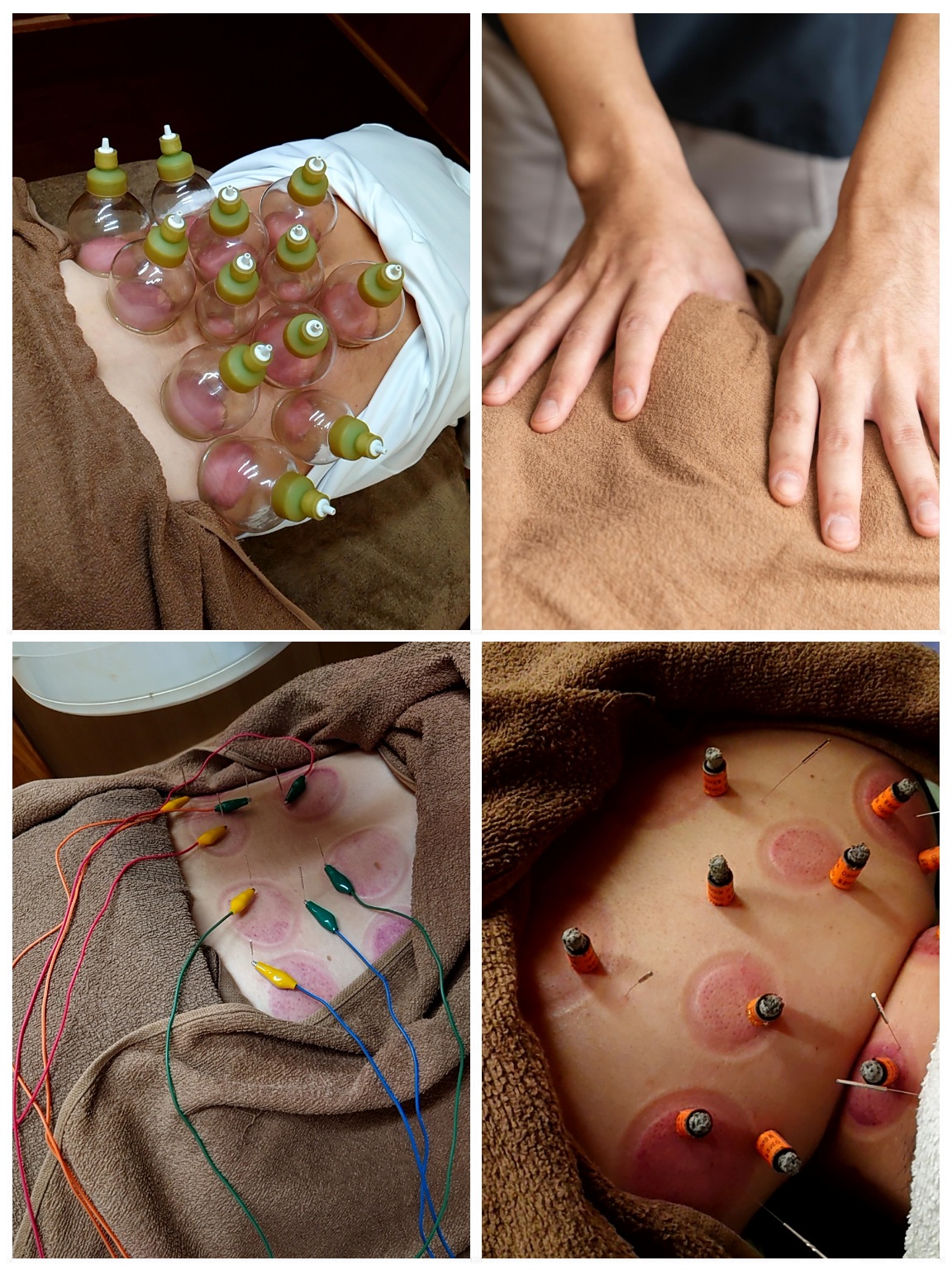 カッピングやはり、きゅう、電気治療、マッサージなど当院で行う施術方法の写真